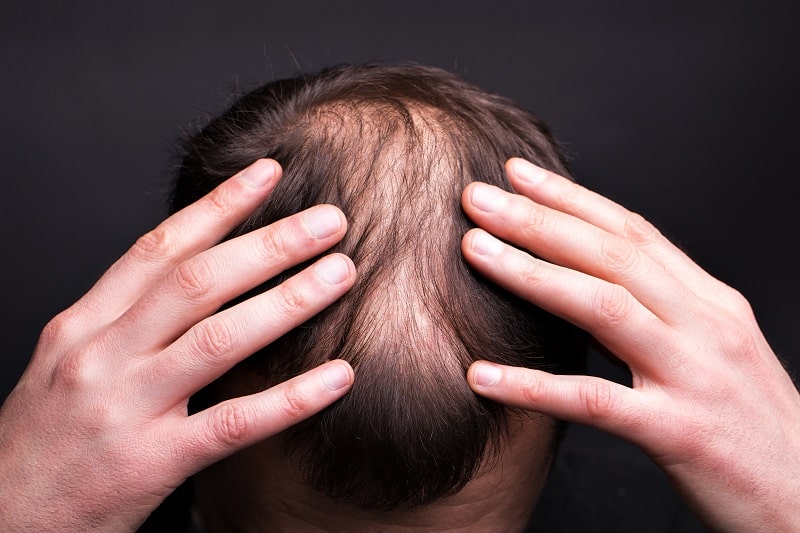 מהו מינוקסידיל ואיך הוא מעכב איבוד שיער
