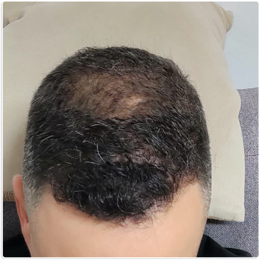 גבר אחרי שעבר טיפול בהתקרחות עם מנטופ