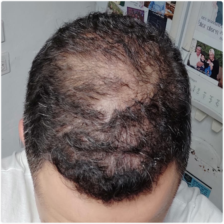 גבר לפני שעבר טיפול בהתקרחות עם מיינטופ