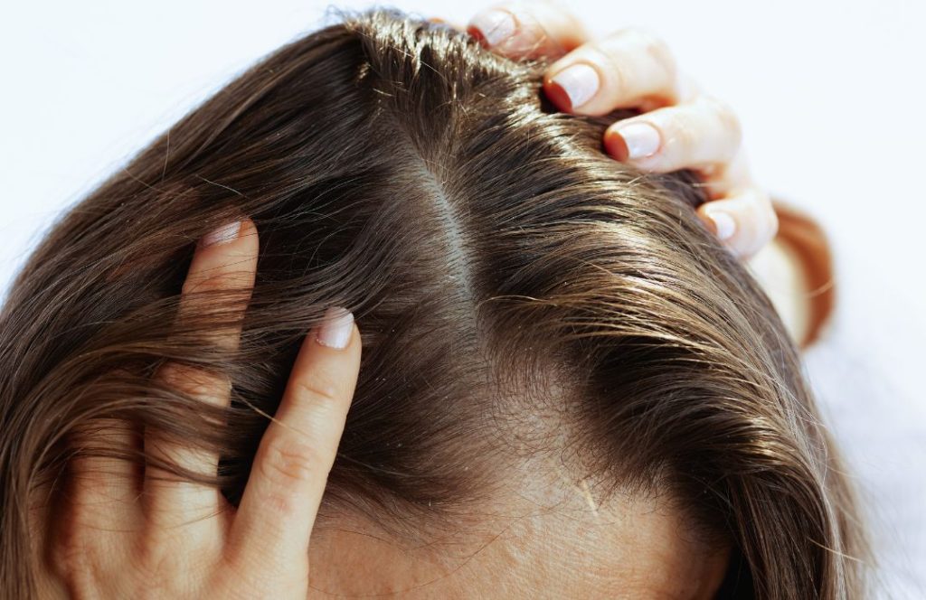 סובלים מקשקשים? גלו איך להיפטר מהם בעזרת פתרונות טבעיים, התאמת שמפו לשיער ושילוב ביוטין לשיער לשיפור בריאות הקרקפת.